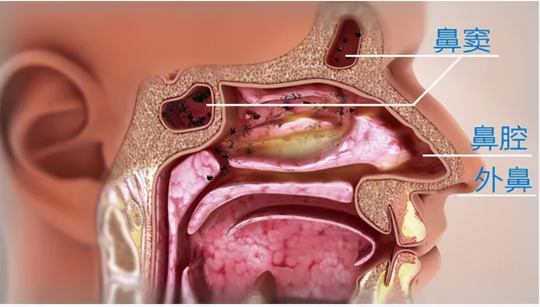 鼻炎 or 鼻窦炎？一鼻之差，症状大不同