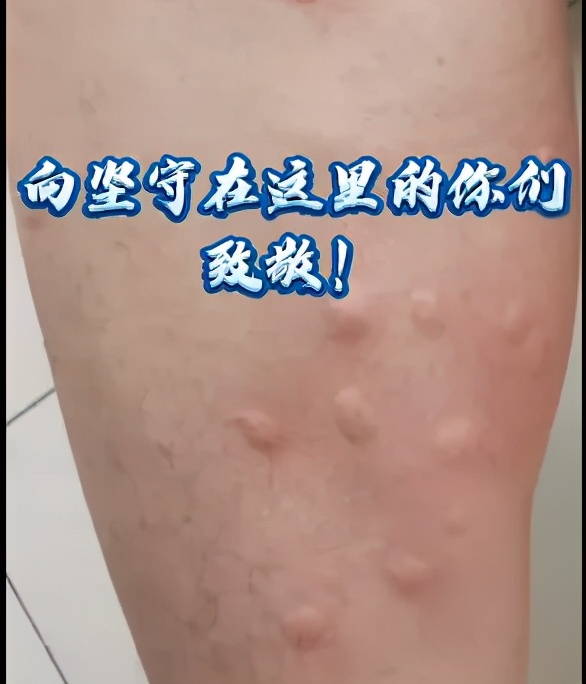 一巴掌拍死100多只蚊子！核技术都不能让蚊子