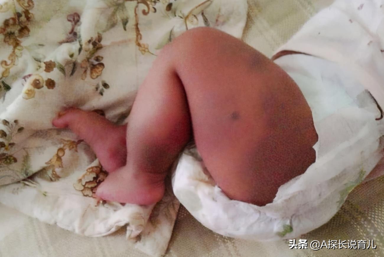 新生儿屁股为何会出现淤青新生孩子屁股上为何会有淤青