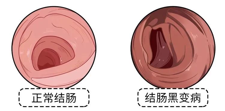 排宿便、清腸毒就能美容減肥？ 不要再信廣告了，坑錢還傷身體