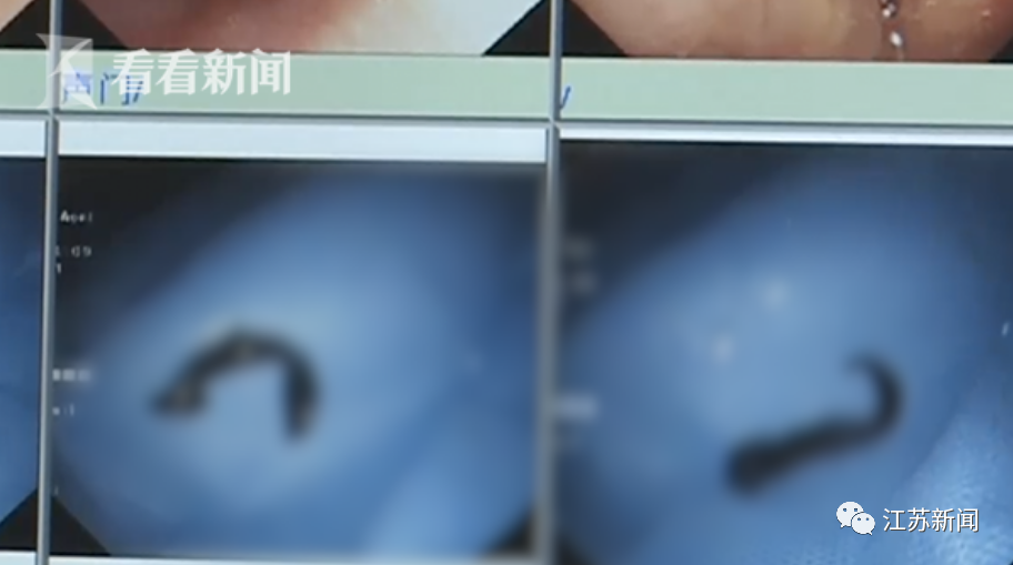 女子喉嚨中取出 5 厘米長(zhǎng)的螞蟥，只因喝了這種水