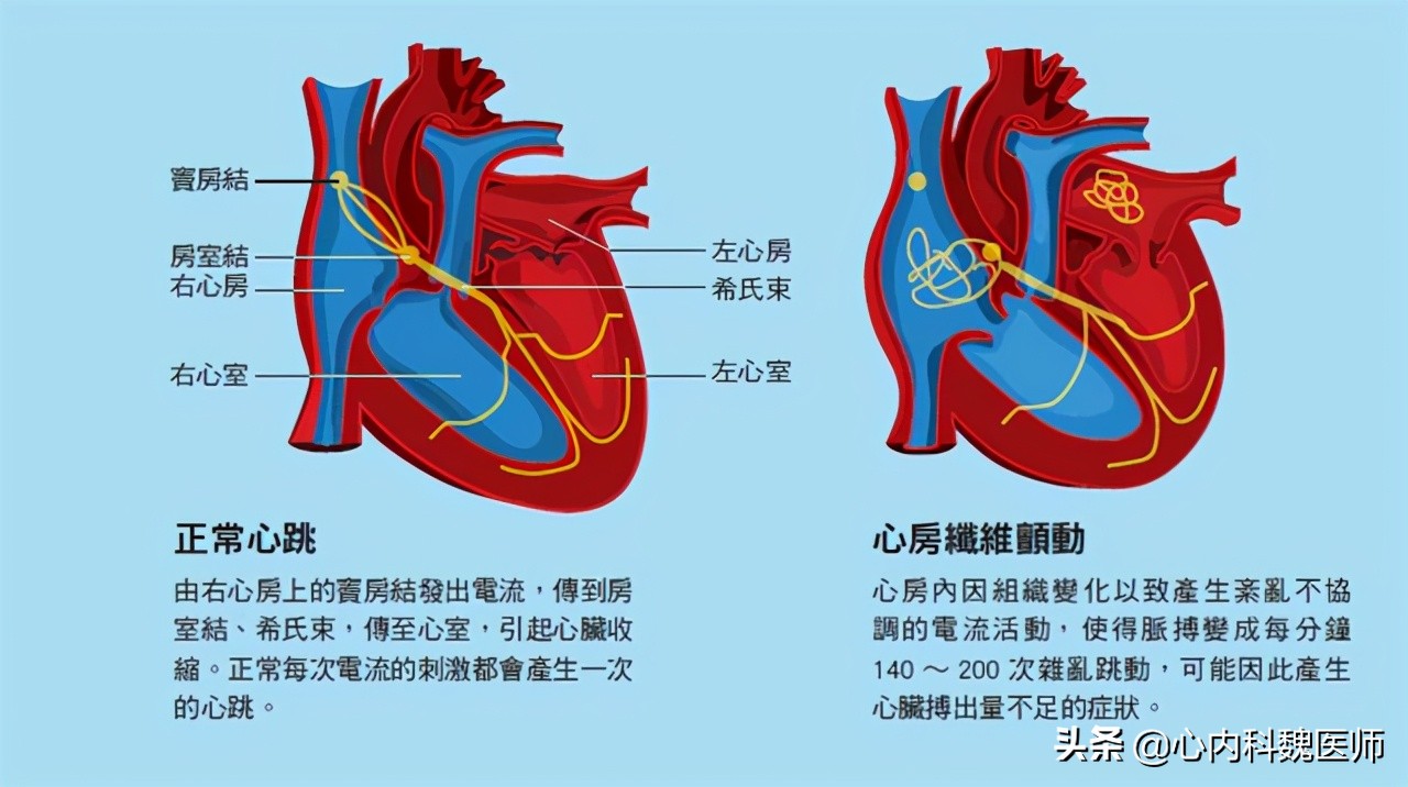心電圖“竇性心律”是什么？早搏是啥感覺？房顫的危害到底多大？