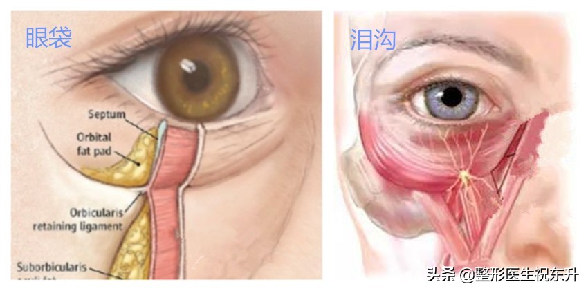 别随便做“眶隔脂肪释放”祛眼袋手术，否则会“后悔”?