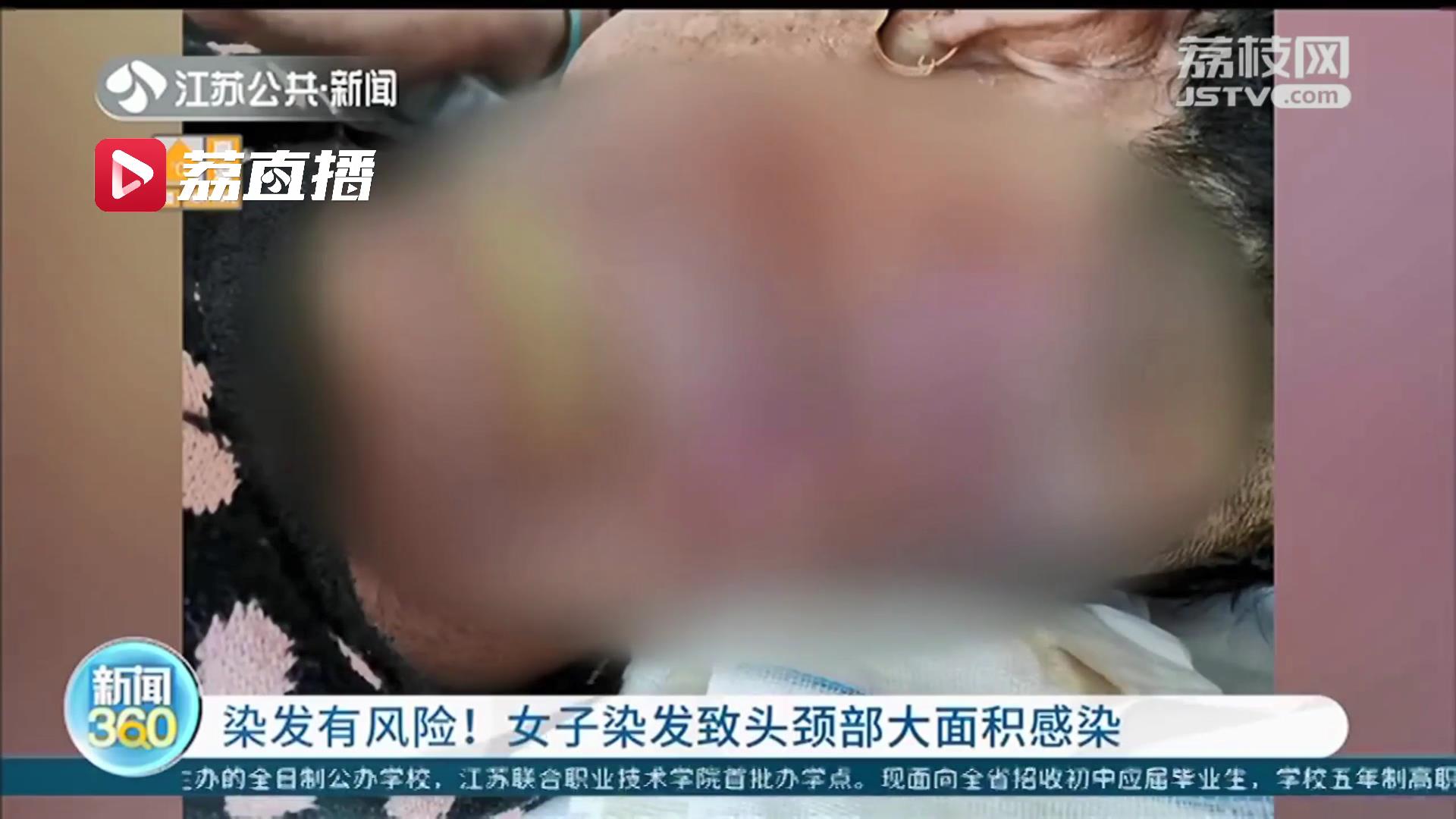 染发有风险！女子染发致头颈部大面积感染 医生建议使用产品前应局部试验