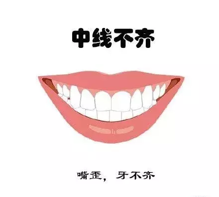 什么牙需要矫正呢？