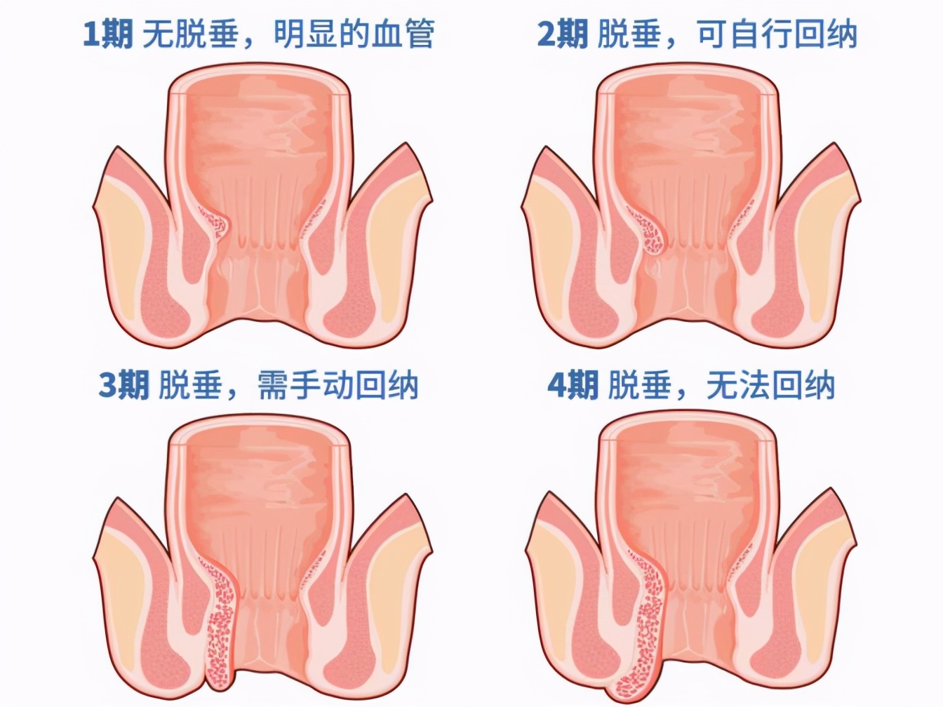 菊情战略局新闻发布会之应对痔疮疫情