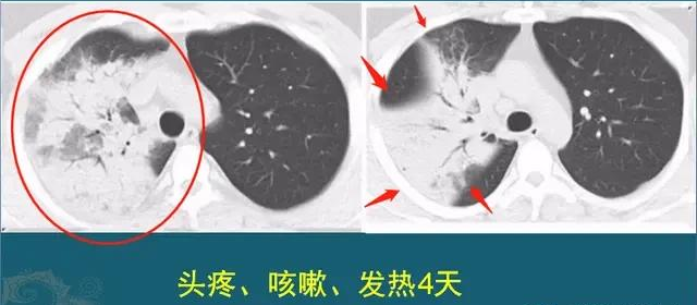 从肺里咳出的痰是什么物质？是体内毒素吗？秋季养肺该怎么做？