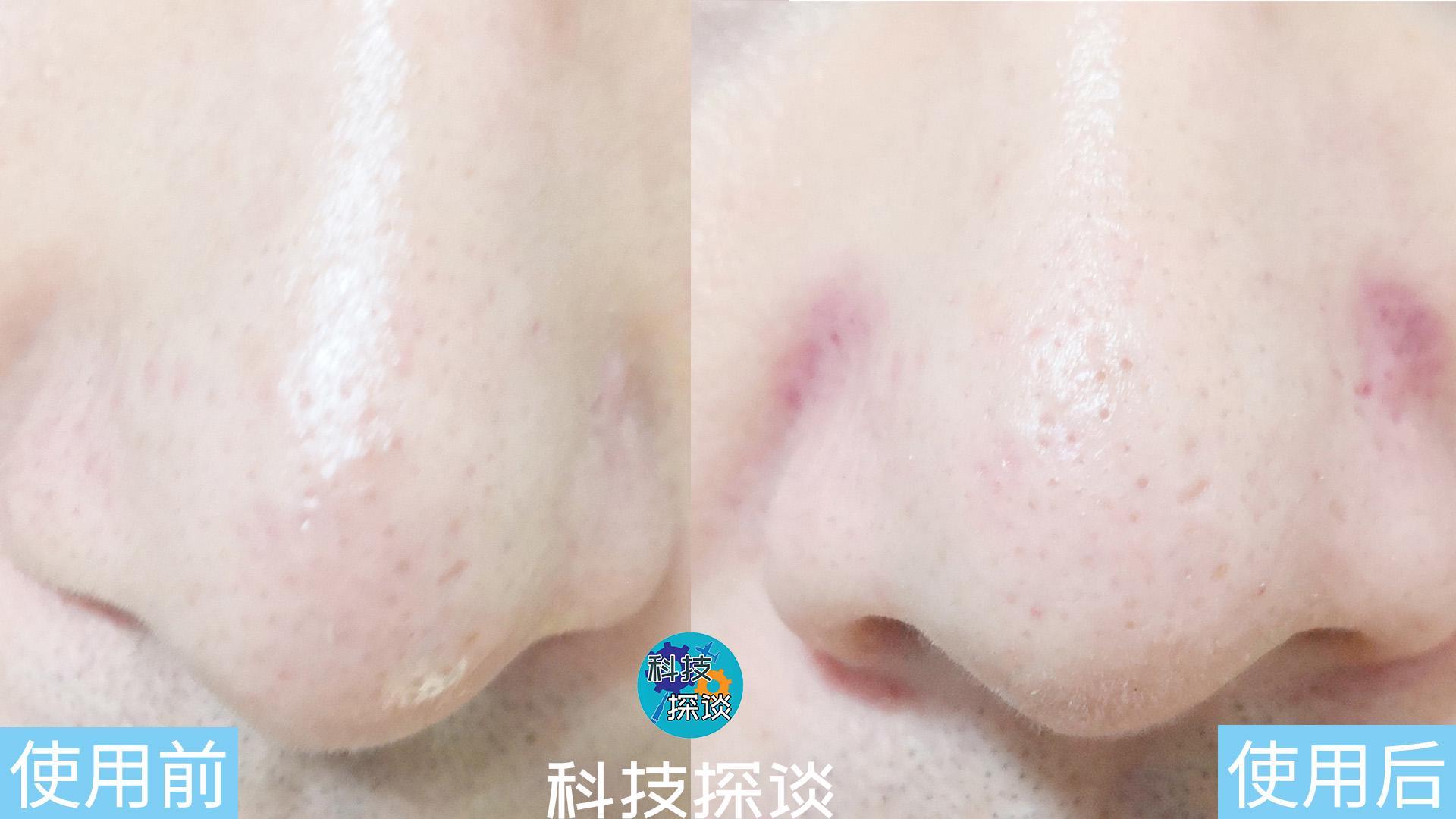 不干吸的百元性价比小气泡黑头仪，用医美的方法赶走黑头