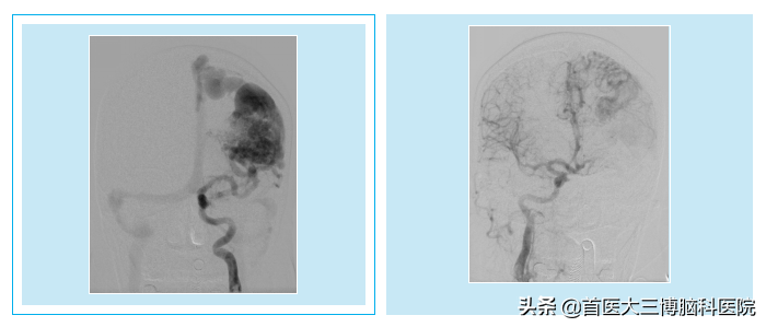 妊娠27周孕妇突发脑出血多学科协作紧急救治 首医大三博脑科医院 Mdeditor