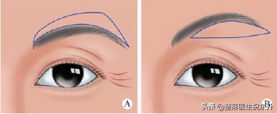 45岁以后打算做“提眉手术”的人，医生告诉你20个真相