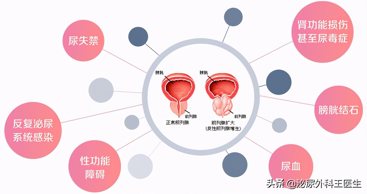 坦索罗辛除了改善尿频，还能治疗良性前列腺增生、早泄等男科疾病