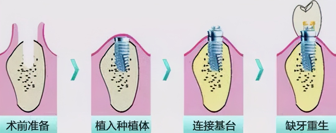 “没牙过了个闹心年”、“年后第一件大事就是做种植牙”