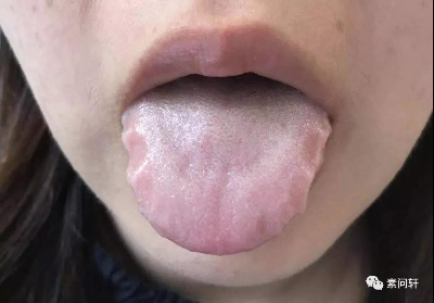 齿痕舌的病因及临床表现