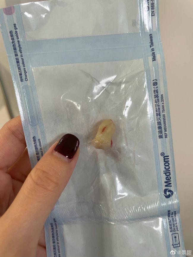 景甜素颜拔牙，拔完脸都肿了，大眼睛泪汪汪，智齿疼起来真要命
