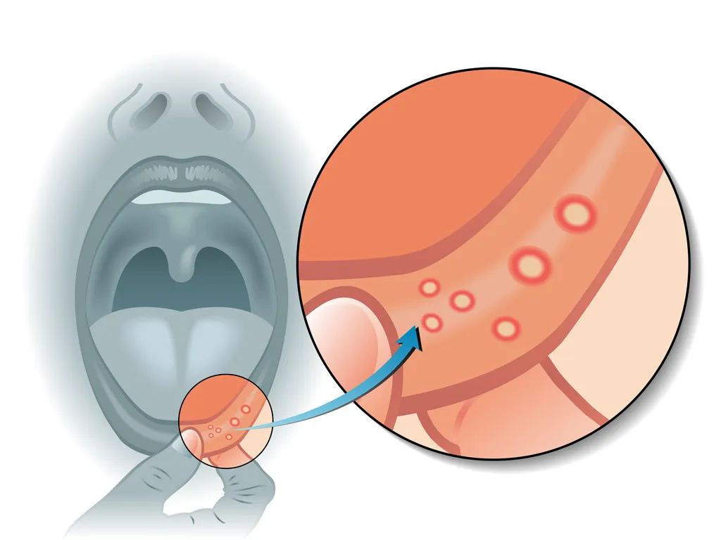 痛！口腔溃疡反复发作，到底什么药管用？