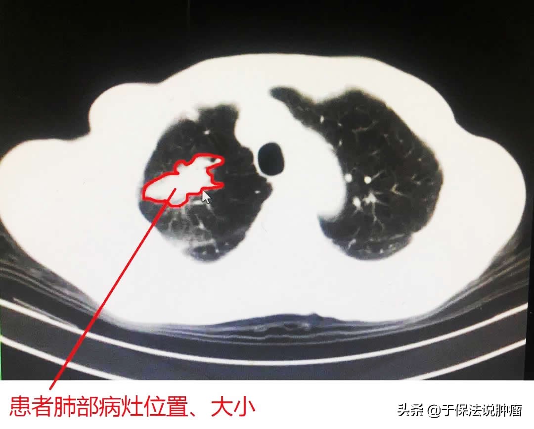 75岁后背疼痛确诊肺癌，拒绝手术化疗，经缓释库治疗改善明显