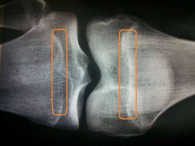 13歲男孩160cm，骨骺線快要閉合，提醒：出現2個特徵前，抓緊補救