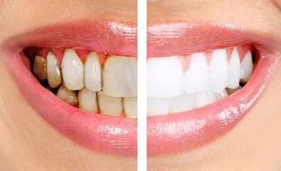 牙齿瓷贴面的优缺点，你知道么？