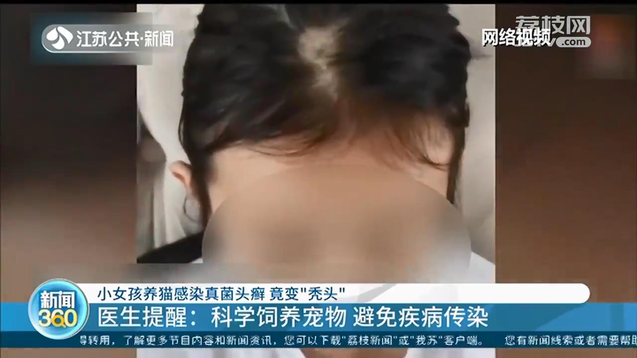 女孩养猫感染真菌头癣变“秃头”，医生：科学养宠物，避免传染病