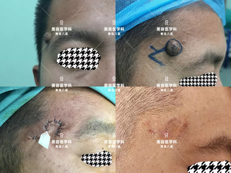技术｜小切口，大学问——青岛市第八人民医院美容医学科