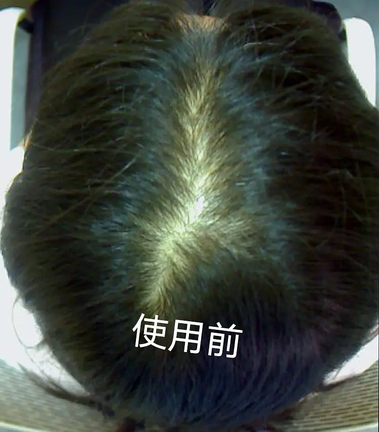 米诺地尔太麻烦，只用非那雄胺能生发？皮肤科医生指导用还是不用