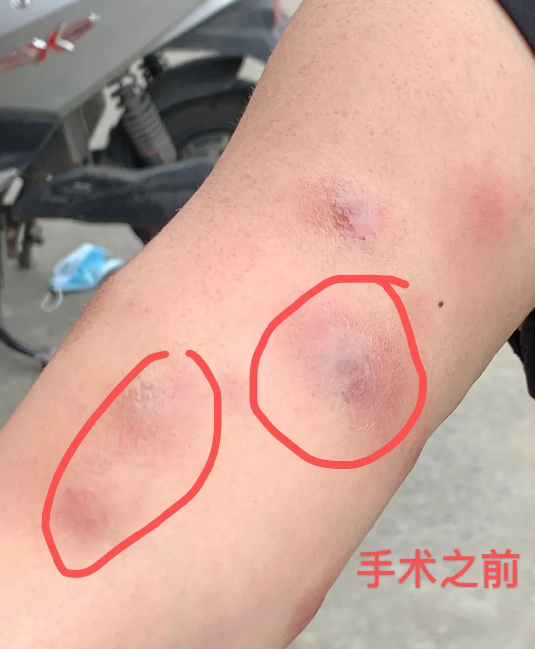 想变瘦却被“千刀万剐”！美女尝试减肥新产品被割成“蜂窝煤”，竟是感染这种细菌