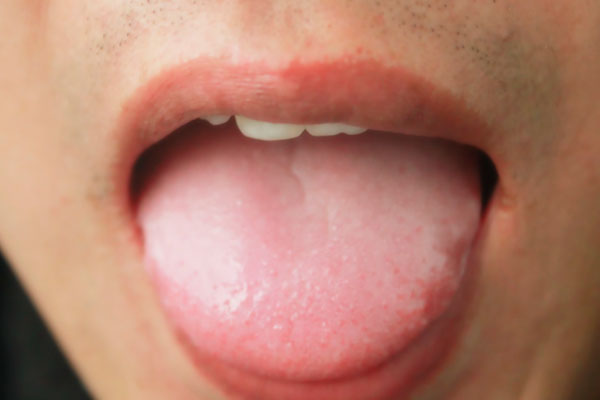 舌头下有青筋，是怎么回事？