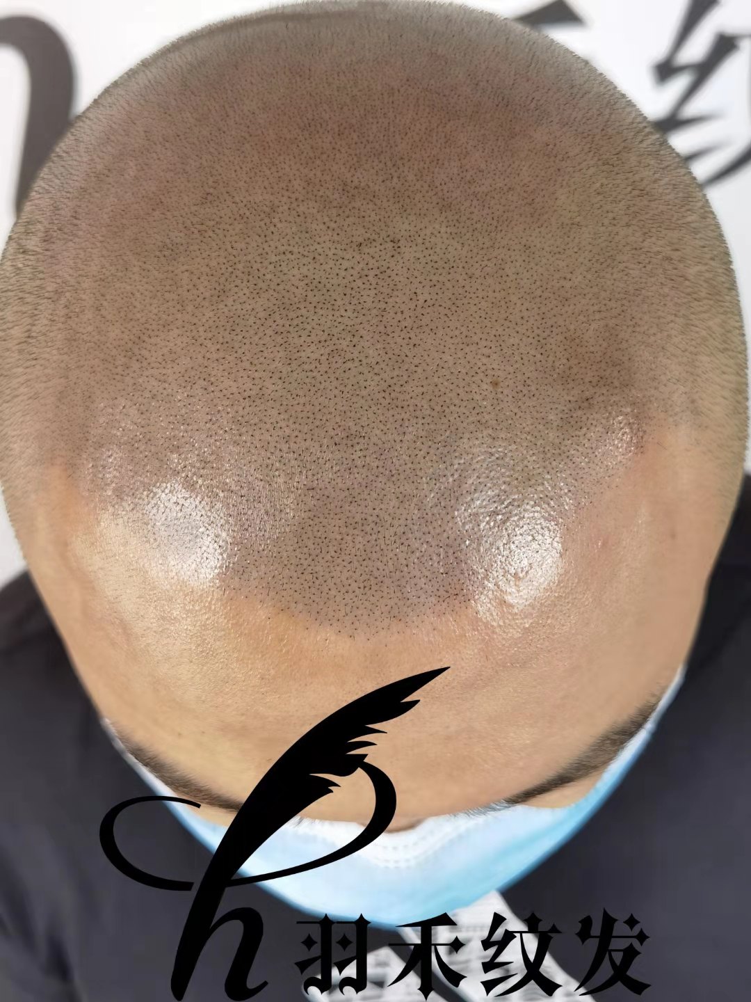 纹发能长头发吗？