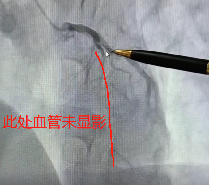 胸口疼了几个月突然不疼了，是不治自愈了吗？不，是心肌死了