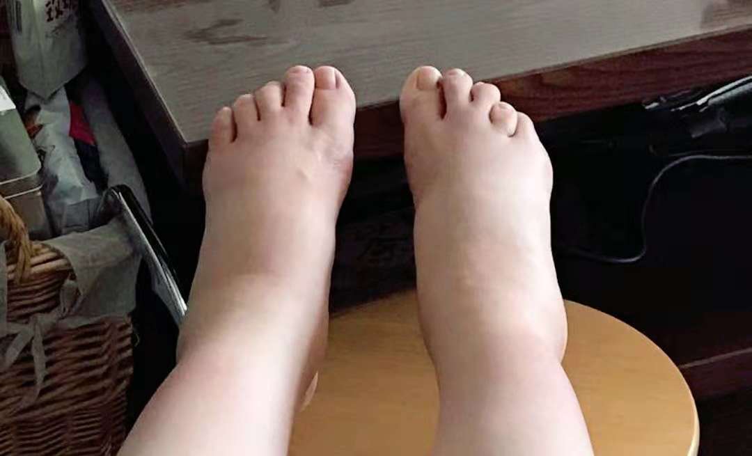 外伤性脂肪坏死是症状恶化的表现，前期症状比较轻，可能不被重视