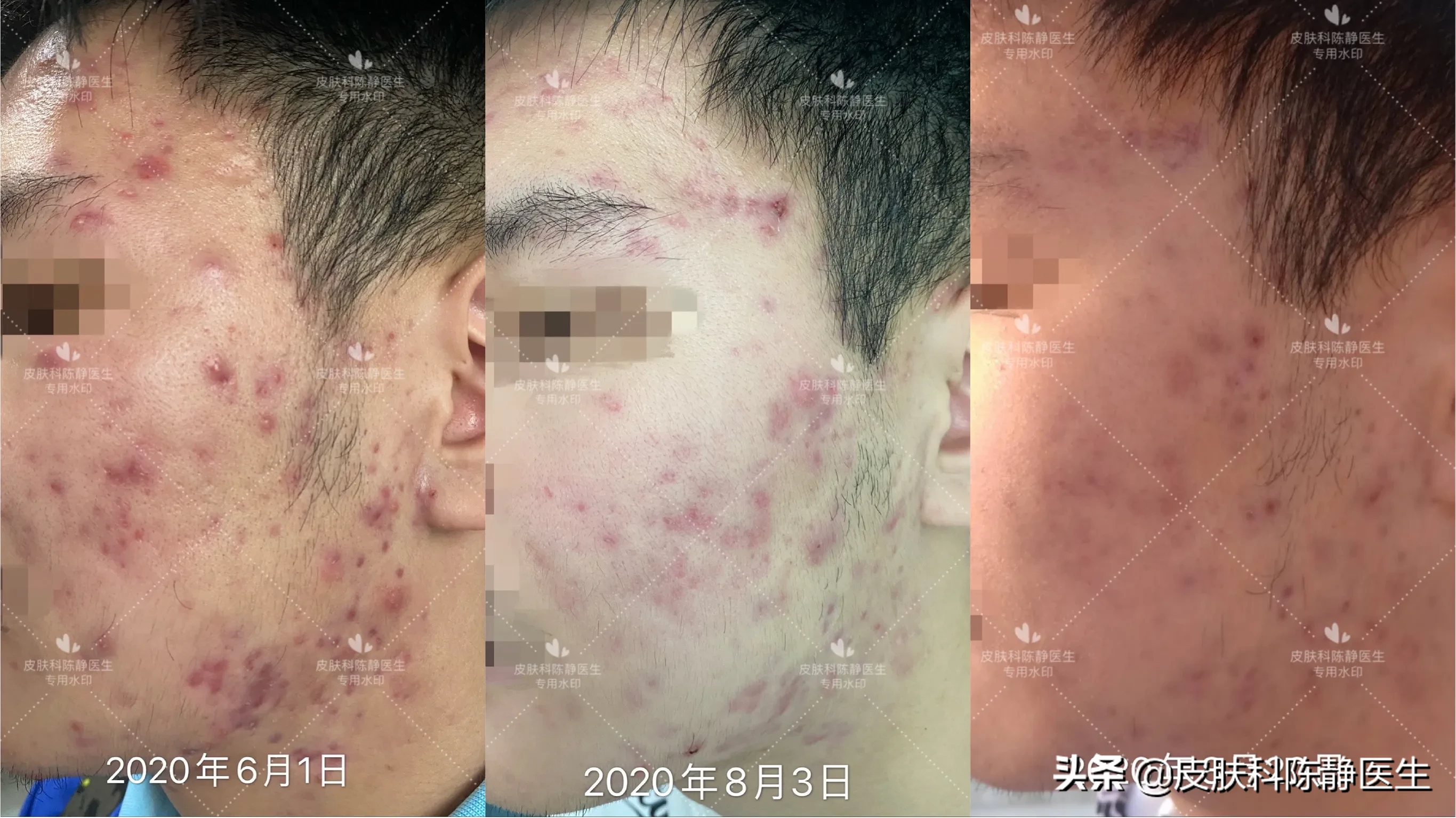 口服异维A酸胶囊,你的脸会有哪些改变?