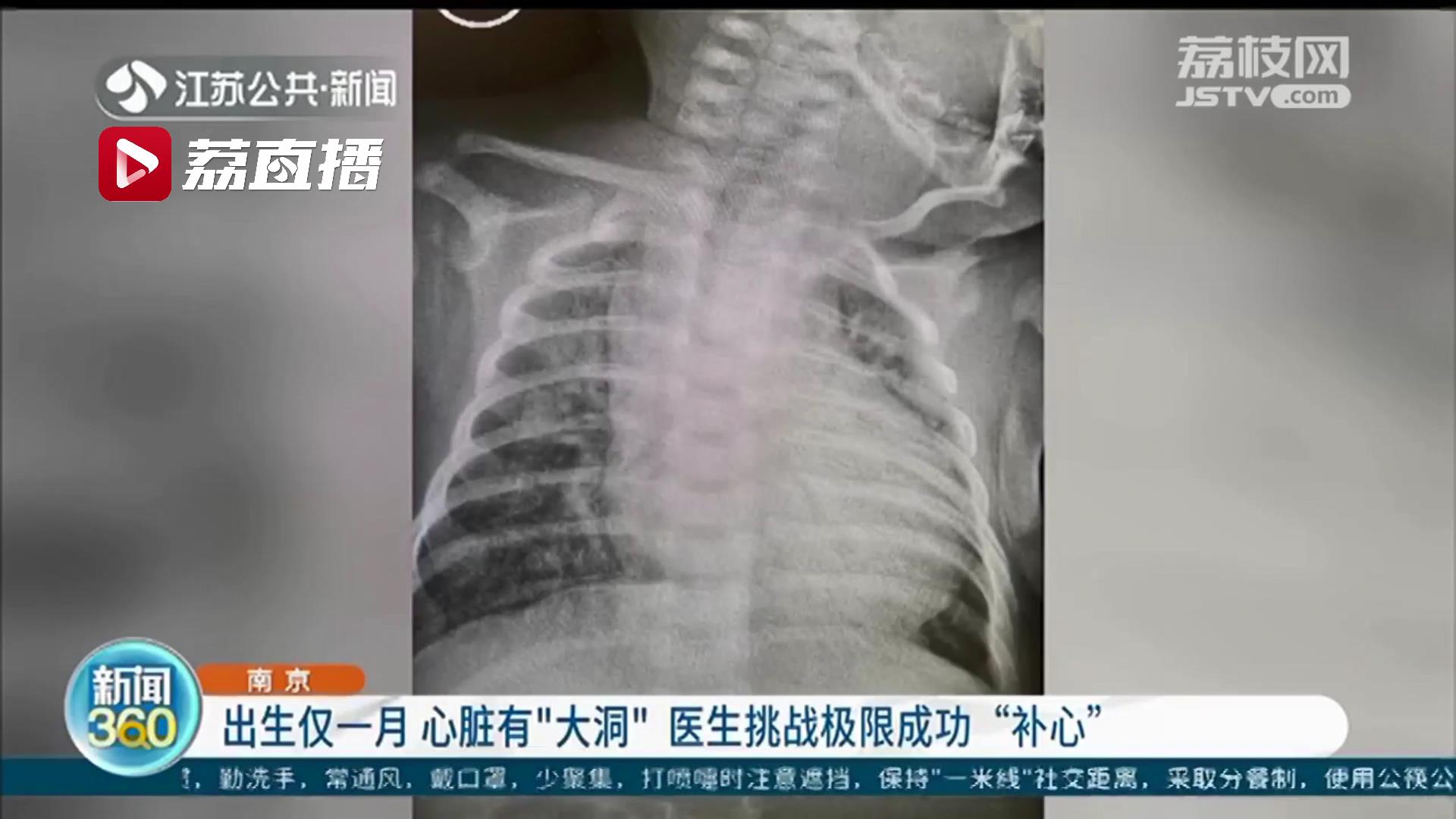 一个月大的婴儿心脏查出有个&ldquo;大洞&rdquo;医生挑战极限成功&ldquo;补心&rdquo;
