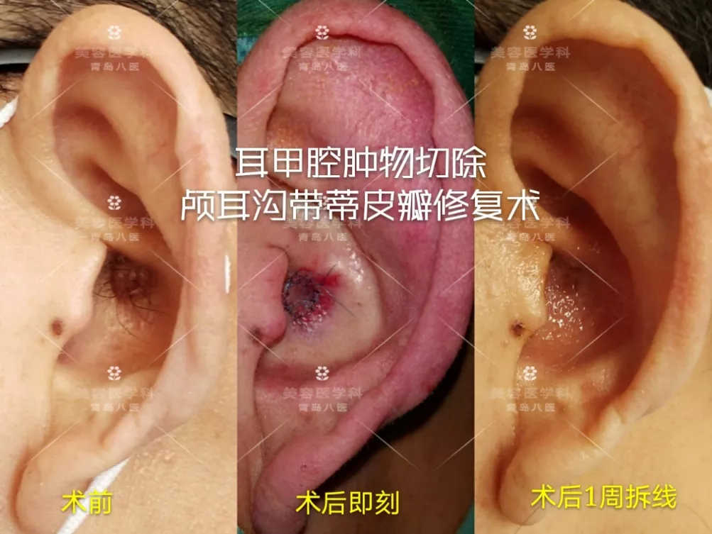 技术｜小切口，大学问——青岛市第八人民医院美容医学科