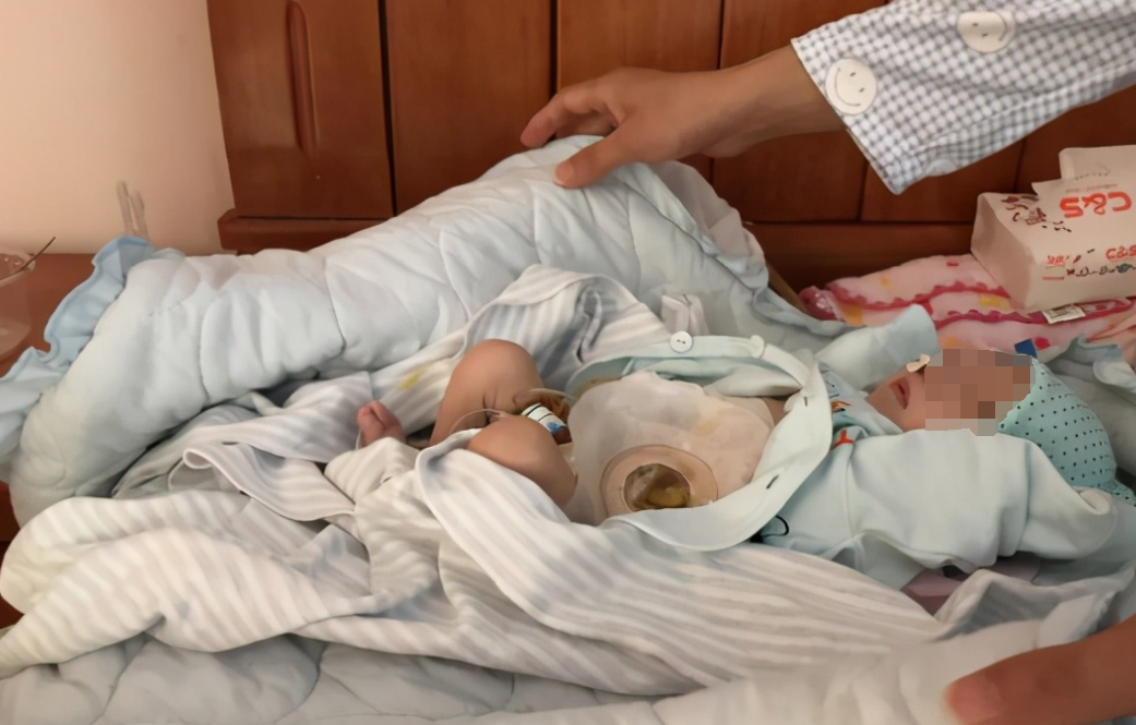 广西一男婴出生第三天被发现没有肛门，16天后因