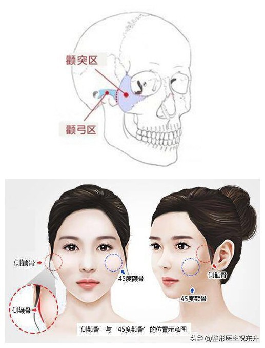 40岁左右，有眼袋、轻度法令纹，更适合做眼袋切口面中部提升