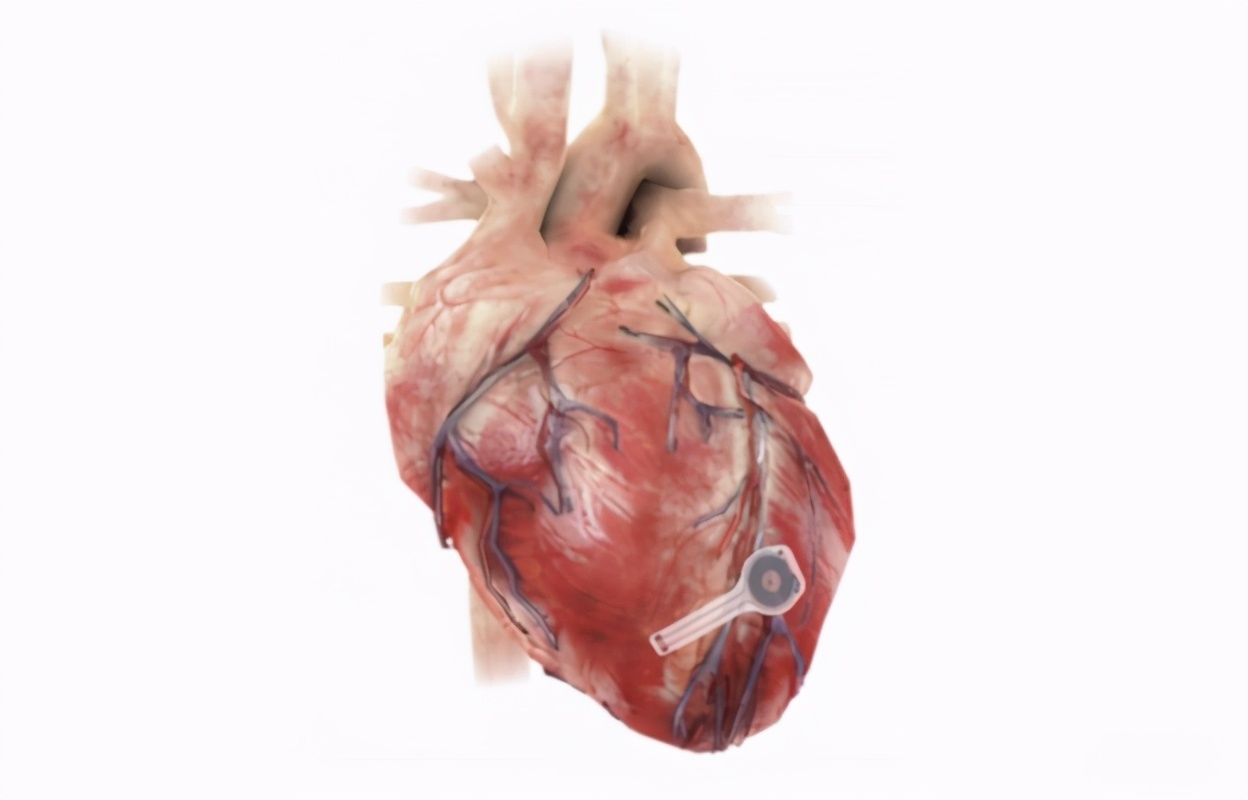 无需取出，美国首创可在体内分解，使用NFC无线技术的心率调节器