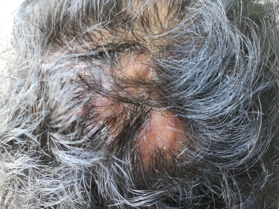 少数可以发生在头顶等处,或和分割性蜂窝织炎伴发,形成窦道迁延难愈.