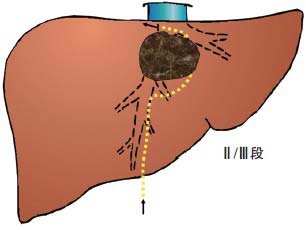 肝胆医生解答：晚期肝癌到底该不该治疗，是不是大家说的人财两空