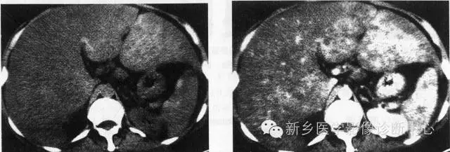 收藏 | 肝脏富血供病变，应想到这16种疾病