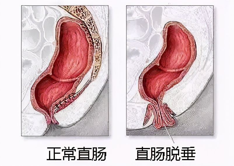 vns86com威尼斯城成功开展我市首例直肠脱垂Delorme手术