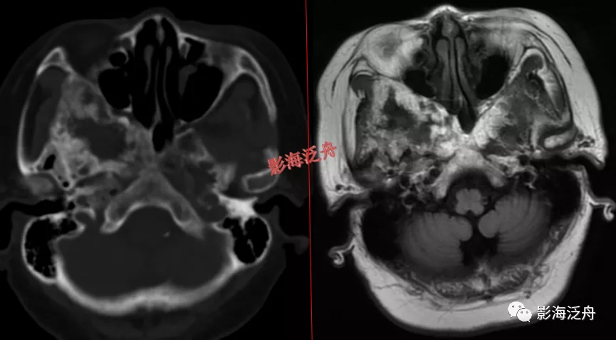 超级干货--颅脑MR中易漏诊点全面总结