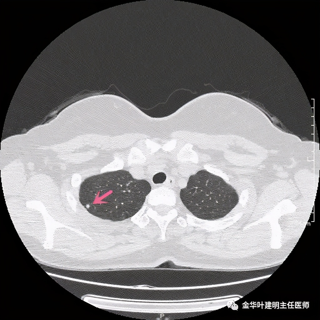 随访明显增大的实性<!--HAODF:8:jiejiebing-->肺结节<!--HAODF:/8:jiejiebing-->肯定是癌吗？要不要手术？
