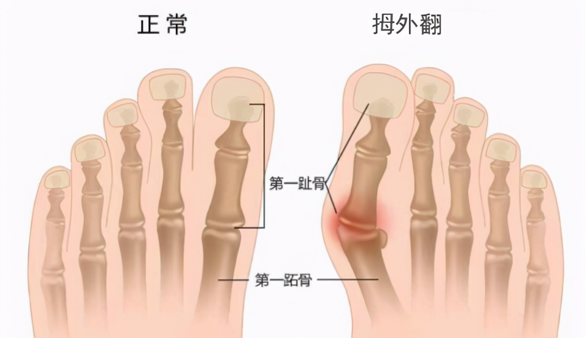 高跟鞋常穿，当心拇外翻