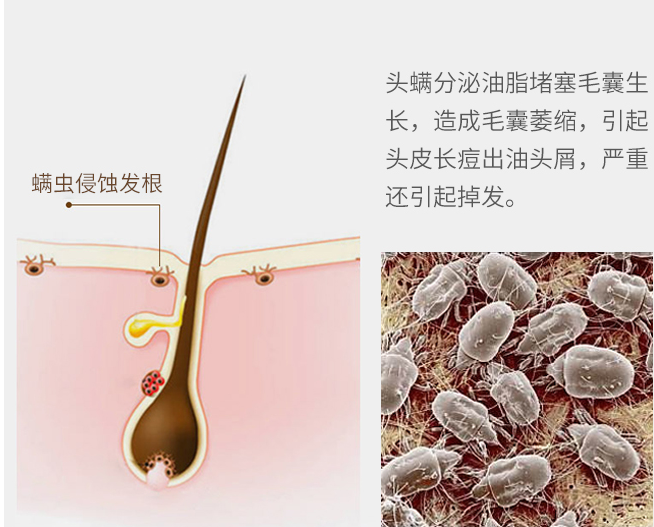歌歌兰妮修护水养洗护｜铲除头螨，拯救头油，三天不用洗头