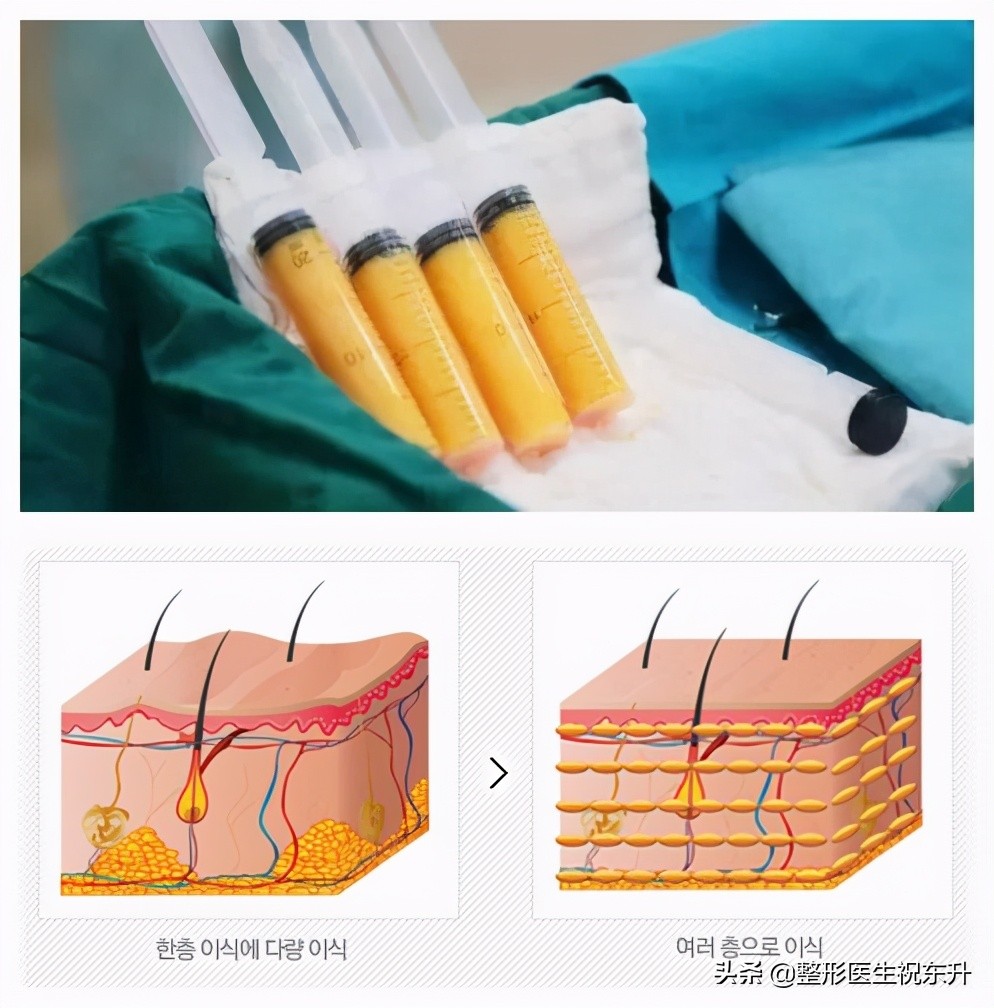 关于“面部脂肪填充”，医生想与你说几句实话
