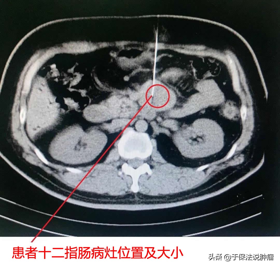 十二指肠肝转移患者经缓释库治疗，病灶消失，取得较满意效果