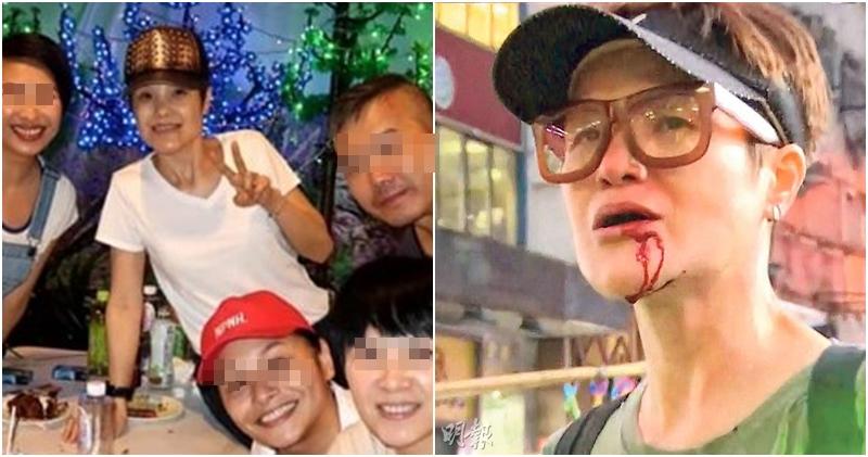 TVB爱国艺人遇袭后现身好友聚会 嘴巴仍见伤痕
