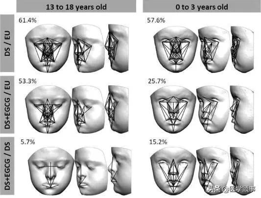低劑量綠茶提取物或能改善唐氏綜合征患者的麵部發育