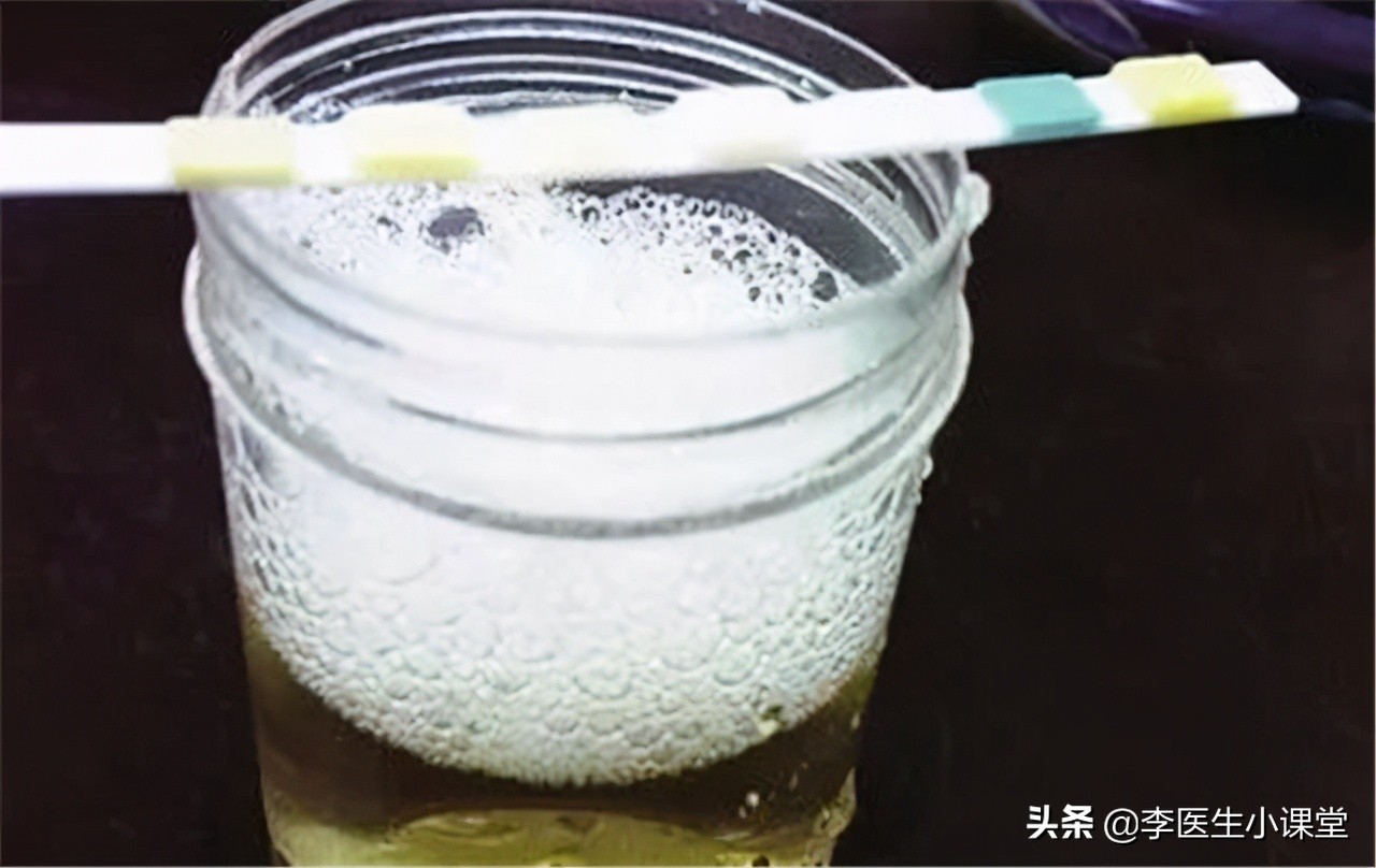 肾功能受损有哪些征兆？医生：除了泡沫尿，这几种症状也要警惕