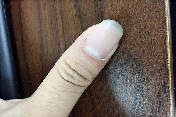 指甲上有凹沟，暗示什么病？